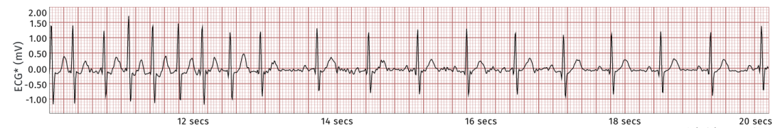 Heart rate spike